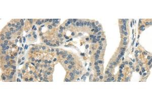 Immunohistochemistry of paraffin-embedded Human thyroid cancer tissue using CCL13 Polyclonal Antibody at dilution 1:40 (CCL13 antibody)
