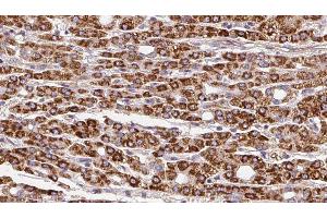 ABIN6279850 at 1/100 staining Human liver cancer tissue by IHC-P. (SLC28A1 antibody  (N-Term))