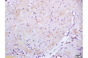 Formalin-fixed and paraffin embedded human gastric carcinoma tissue labeled with Anti ROCK2 Polyclonal Antibody, unconjugated (ABIN673359) at 1:200 followed by incubation with conjugated secondary antibody and DAB staining