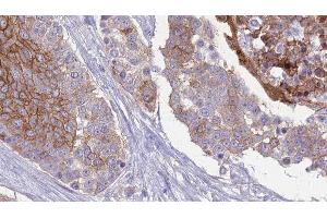 ABIN6277181 at 1/100 staining Human urothelial cancer tissue by IHC-P. (RAPGEF3 antibody  (C-Term))