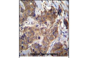 ATP6V1B1 Antibody (C-term) (ABIN656224 and ABIN2845541) immunohistochemistry analysis in formalin fixed and paraffin embedded human breast carcinoma followed by peroxidase conjugation of the secondary antibody and DAB staining. (ATP6V1B1 antibody  (C-Term))