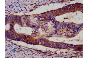 IHC image of ABIN7145547 diluted at 1:1200 and staining in paraffin-embedded human colon cancer performed on a Leica BondTM system. (BID antibody  (AA 1-195))