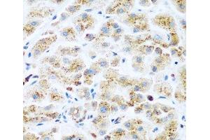 Immunohistochemistry of paraffin-embedded Human liver cancer using KIAA1456 Polyclonal Antibody at dilution of 1:200 (40x lens). (KIAA1456 antibody)
