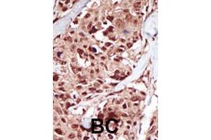 Formalin-fixed and paraffin-embedded human cancer tissue reacted with the primary antibody, which was peroxidase-conjugated to the secondary antibody, followed by AEC staining. (BRD4 antibody  (N-Term))