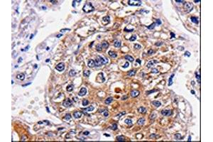 The image is immunohistochemistry of paraffin-embedded Human liver cancer tissue using (ALK Antibody) at dilution 1/25. (ALK antibody)