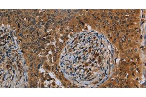Immunohistochemistry of paraffin-embedded Human cervical cancer tissue using OSM Polyclonal Antibody at dilution 1:40