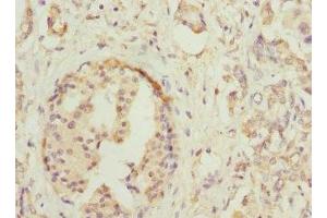 Immunohistochemistry of paraffin-embedded human pancreatic cancer using ABIN7155761 at dilution of 1:100 (HOXD1 antibody  (AA 1-240))