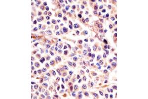 (ABIN6242397 and ABIN6578004) staining IL24 in human melanoma sections by Immunohistochemistry (IHC-P - paraformaldehyde-fixed, paraffin-embedded sections). (IL-24 antibody)