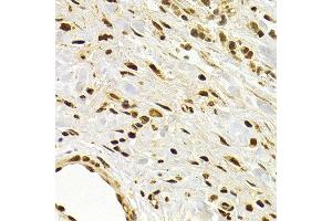 Immunohistochemistry of paraffin-embedded human stomach cancer using DNMT3A antibody at dilution of 1:200 (400x lens). (DNMT3A antibody)