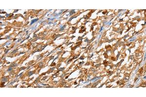 Immunohistochemistry of paraffin-embedded Human esophagus cancer using CAPG Polyclonal Antibody at dilution of 1:40 (CAPG antibody)