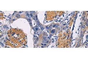 Immunohistochemistry of paraffin-embedded Human esophagus cancer tissue using FAM20C Polyclonal Antibody at dilution of 1:45(x200)