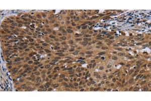 Immunohistochemistry of paraffin-embedded Human cervical cancer using CEBPD Polyclonal Antibody at dilution of 1:40 (CEBPD antibody)