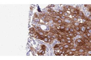 ABIN6276987 at 1/100 staining Human Head and neck cancer tissue by IHC-P. (HVEM antibody  (C-Term))