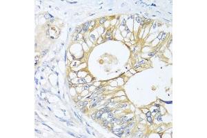 Immunohistochemistry of paraffin-embedded human colon carcinoma using GN antibody  at dilution of 1:100 (40x lens). (GNAI3 antibody  (AA 1-100))