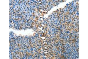 Immunohistochemical analysis of paraffin-embedded Human liver cancer tissue using at dilution 1/25.