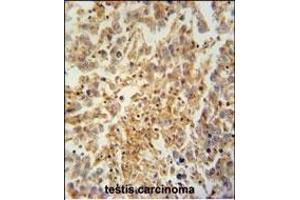TEX9 antibody (N-term) (ABIN654569 and ABIN2844274) immunohistochemistry analysis in formalin fixed and paraffin embedded human testis carcinoma followed by peroxidase conjugation of the secondary antibody and DAB staining. (TEX9 antibody  (N-Term))