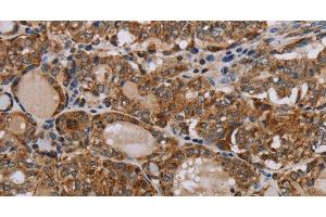 Immunohistochemistry of paraffin-embedded Human thyroid cancer tissue using MT-ND6 Polyclonal Antibody at dilution 1:40 (MT-ND6 antibody)