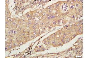 Formalin-fixed and paraffin embedded human lung carcinoma labeled with Anti-CD44 Polyclonal Antibody, Unconjugated  at 1:200 followed by conjugation to the secondary antibody and DAB staining (CD44 antibody  (AA 325-429))