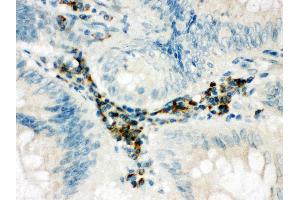 Anti-SPARCL1 antibody, IHC(P) IHC(P): Human Intestinal Cancer Tissue (SPARCL1 antibody  (C-Term))