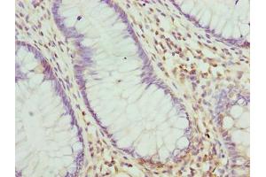 Immunohistochemistry of paraffin-embedded human colon cancer using ABIN7168234 at dilution of 1:100 (RING1 antibody  (AA 401-630))