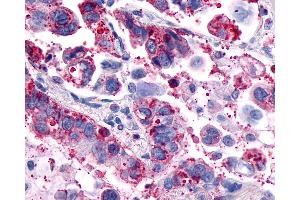 Anti-GPR4 antibody IHC of human Lung, Adenocarcinoma. (GPR4 antibody  (Cytoplasmic Domain))