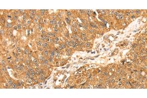 Immunohistochemistry of paraffin-embedded Human breast cancer using ERK 5 Polyclonal Antibody at dilution of 1:35 (MAPK7 antibody)