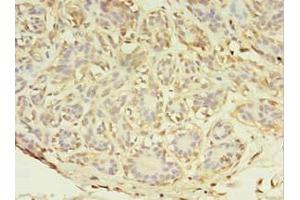 Immunohistochemistry of paraffin-embedded human breast cancer using ABIN7143952 at dilution of 1:100 (ABHD14A antibody  (AA 56-258))