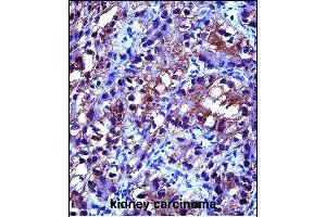 CRYA Antibody (Center) (ABIN657620 and ABIN2846616) immunohistochemistry analysis in formalin fixed and paraffin embedded human kidney carcinoma followed by peroxidase conjugation of the secondary antibody and DAB staining. (CRYAB antibody  (AA 84-112))