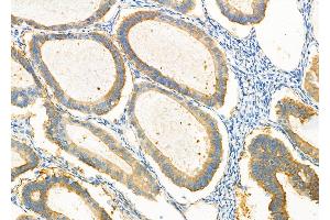 ABIN6265225 and ABIN6277101 at 1/100 staining human ovarian cancer by IHC-P. (SORD antibody  (Internal Region))