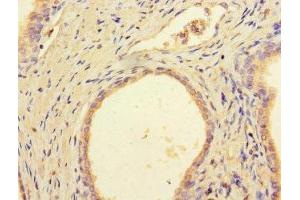 Immunohistochemistry of paraffin-embedded human prostate cancer using ABIN7149526 at dilution of 1:100 (DCAF8 antibody  (AA 1-135))