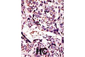 Formalin-fixed and paraffin-embedded human hepatocellular carcinoma tissue reacted with ARL1 polyclonal antibody  , which was peroxidase-conjugated to the secondary antibody, followed by DAB staining . (ARL1 antibody  (N-Term))