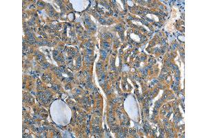 Immunohistochemistry of Human liver cancer using ADCY4 Polyclonal Antibody at dilution of 1:45