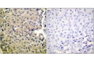 Immunohistochemistry analysis of paraffin-embedded human breast carcinoma, using PP1-alpha (Phospho-Thr320) Antibody. (PPP1CA antibody  (pThr320))
