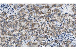 ABIN6275089 at 1/100 staining Human liver cancer tissue by IHC-P. (MYLIP antibody  (Internal Region))
