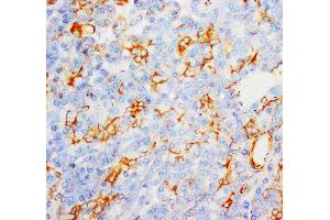 Anti-Myeloperoxidase antibody, IHC(P) IHC(P): Human Liver Cancer Tissue (Myeloperoxidase antibody  (C-Term))
