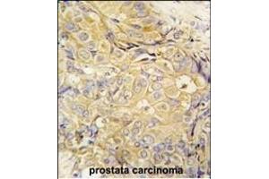 Formalin-fixed and paraffin-embedded human prostata carcinoma tissue reacted with FGF10 antibody (C-term) (ABIN392510 and ABIN2842073) , which was peroxidase-conjugated to the secondary antibody, followed by DAB staining. (FGF10 antibody  (C-Term))