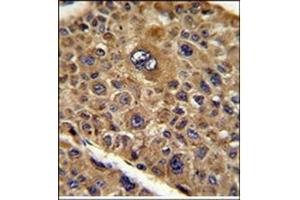 Formalin-Fixed, Paraffin-Eembedded Human hepatocarcinoma reacted with TOB1 Antibody (N-term), which was peroxidase-conjugated to the secondary antibody, followed by DAB staining. (Protein Tob1 (TOB1) (AA 61-91), (N-Term) antibody)