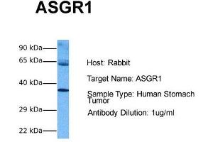 Host: Rabbit Target Name: ASGR1 Sample Tissue: Human Stomach Tumor Antibody Dilution: 1. (Asialoglycoprotein Receptor 1 antibody  (Middle Region))