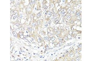 Immunohistochemistry of paraffin-embedded Human liver cancer using ATP1B1 Polyclonal Antibody at dilution of 1:100 (40x lens). (ATP1B1 antibody)