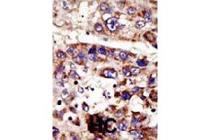 Formalin-fixed and paraffin-embedded human hepatocellular carcinoma tissue reacted with ZMPSTE24 polyclonal antibody  , which was peroxidase-conjugated to the secondary antibody, followed by DAB staining . (ZMPSTE24 antibody  (C-Term))