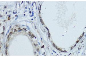 Immunohistochemistry of paraffin-embedded Human gastric cancer using NR1I3 Polyclonal Antibody at dilution of 1:200 (40x lens). (NR1I3 antibody)