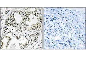 Immunohistochemistry analysis of paraffin-embedded human breast carcinoma, using YEATS2 Antibody. (YEATS2 antibody  (AA 341-390))