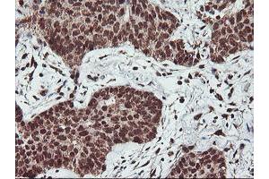 Immunohistochemical staining of paraffin-embedded Carcinoma of Human lung tissue using anti-PDE4B mouse monoclonal antibody. (PDE4B antibody)