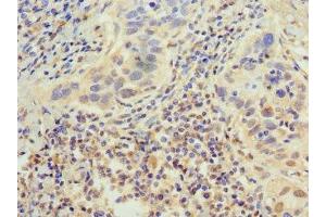 Immunohistochemistry of paraffin-embedded human bladder cancer using ABIN7155286 at dilution of 1:100 (PTGER3 antibody  (AA 2283-2414))