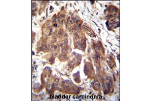 GLMN Antibody (C-term) (ABIN655986 and ABIN2845370) immunohistochemistry analysis in formalin fixed and paraffin embedded human bladder carcinoma followed by peroxidase conjugation of the secondary antibody and DAB staining. (GLMN antibody  (C-Term))
