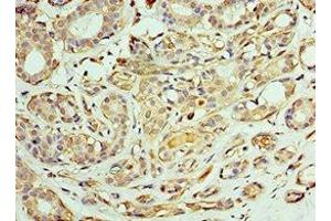 Immunohistochemistry of paraffin-embedded human breast cancer using ABIN7171432 at dilution of 1:100 (CCT6A antibody  (AA 80-250))
