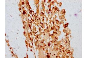 IHC image of ABIN7150243 diluted at 1:400 and staining in paraffin-embedded human melanoma performed on a Leica BondTM system. (POLE4 antibody  (AA 8-117))