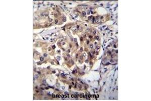 hCG_1995004 Antibody (Center) (ABIN655542 and ABIN2850483) immunohistochemistry analysis in formalin fixed and paraffin embedded human breast carcinoma followed by peroxidase conjugation of the secondary antibody and DAB staining. (hCG_1995004 (AA 116-144) antibody)
