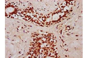 IHC image of ABIN7170858 diluted at 1:400 and staining in paraffin-embedded human breast cancer performed on a Leica BondTM system. (SMC1B antibody  (AA 954-1060))
