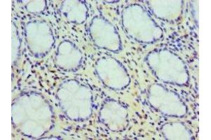 使用1:100稀释的ABIN714795（胆囊收缩素抗体（AA 21-115））进行石蜡包埋的人结肠癌的免疫组织化学